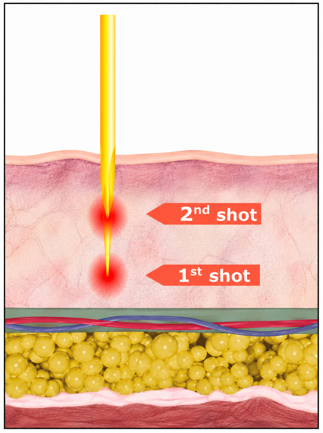 Dual-depth RF delivery showing first and second treatment shots