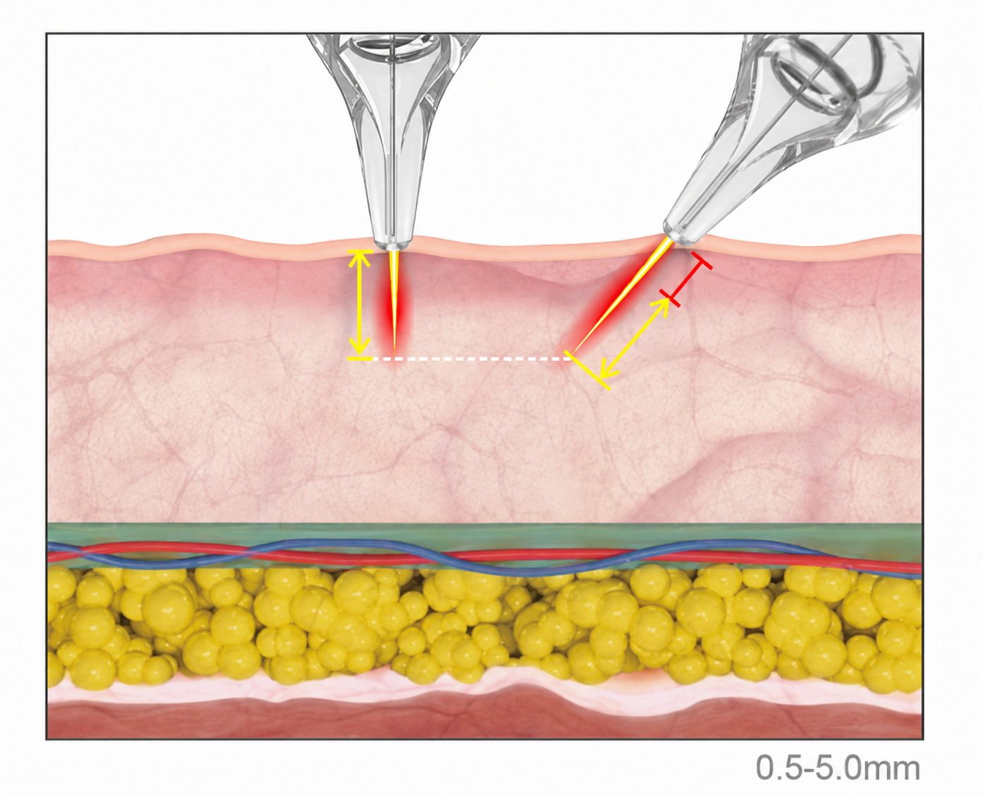 Single needle RF depth and angle illustration